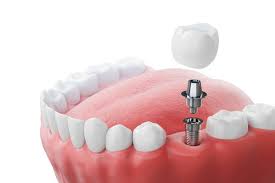 Best Dental Clinic for Dental Implants in Ghatkopar