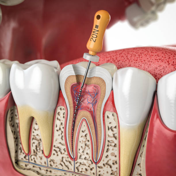 Best Dental Clinic for Painless Root Canal in Ghatkopar